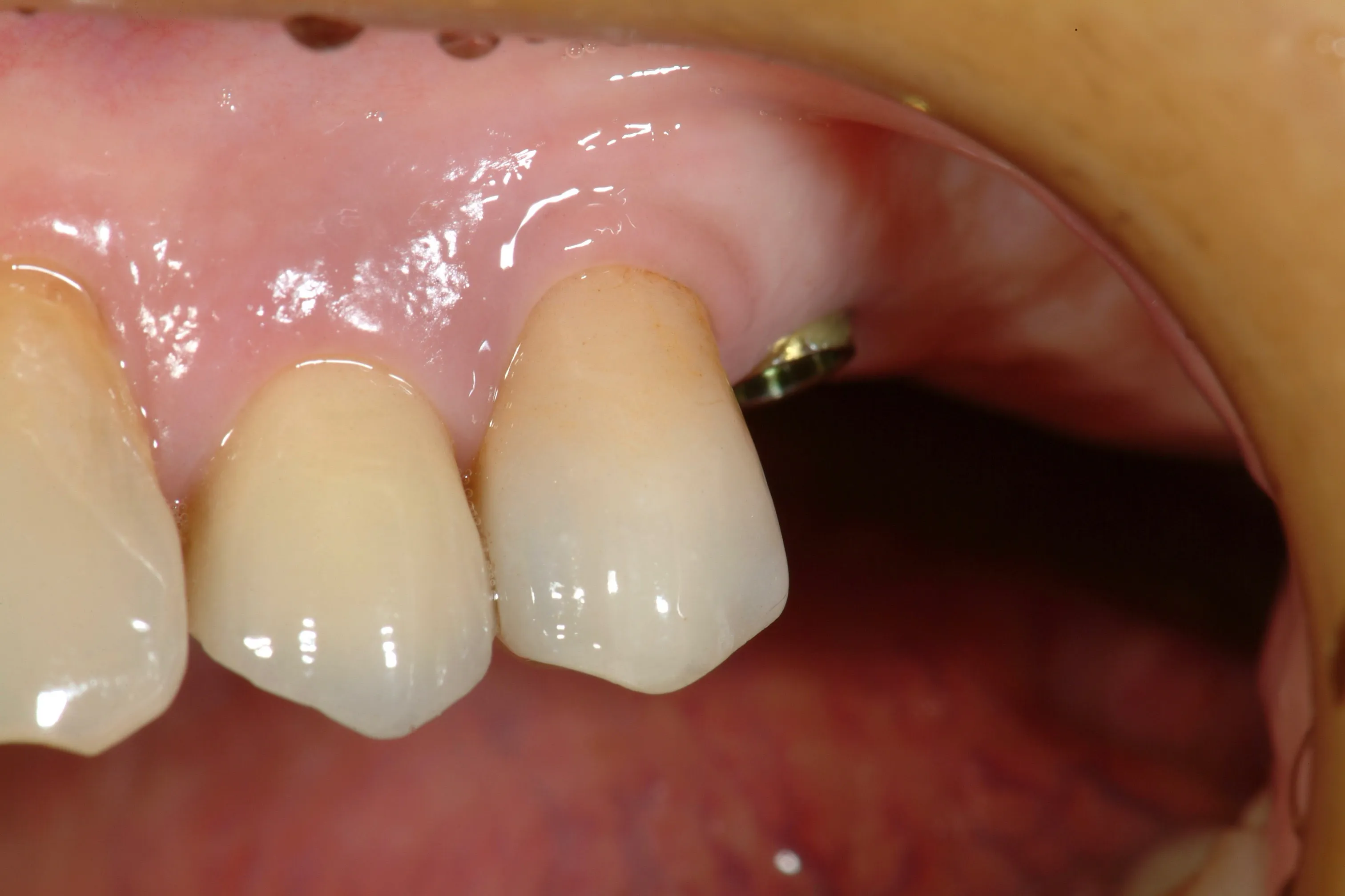Prima del trattamento - Riabilitazione implanto-protesica